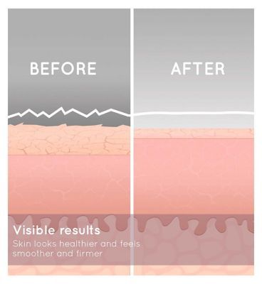 HoMedics Radiance Microdermabrasion