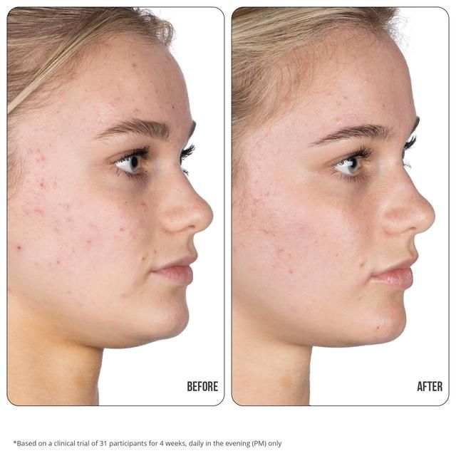 Nip+Fab Retinol Fix Blemish Treatment Gel 10% 15ml