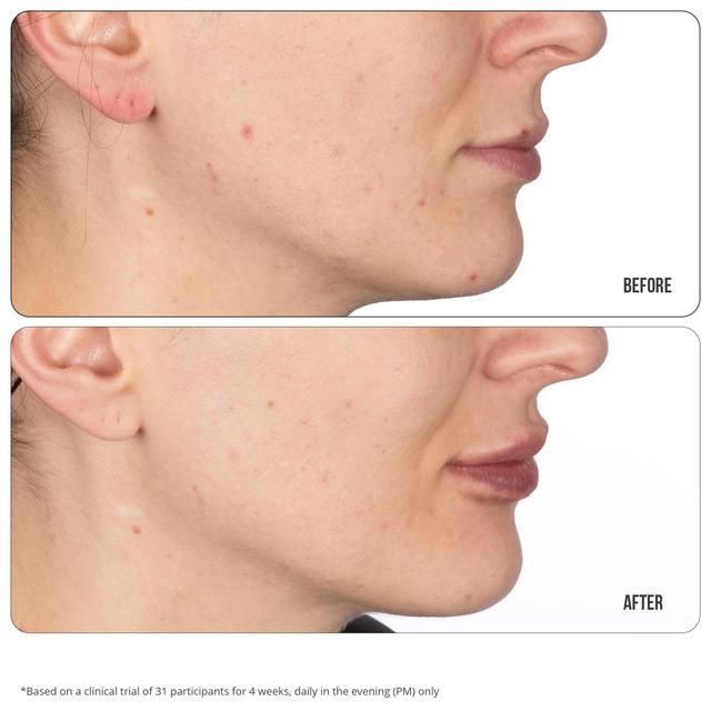 Nip+Fab Retinol Fix Blemish Treatment Gel 10% 15ml