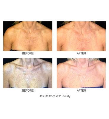 Rio DecoLITE Beauty boost LED light Treatment