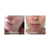 Science of Skin Rescue Acne Scarring 30ml