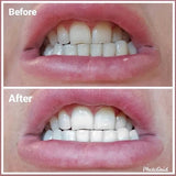 SmileTime ST01 Teeth Stain Remover