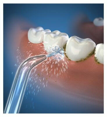 Waterpik Cordless Replacement High Pressure Jet Tip JT-450E 2 Count Dental Boots